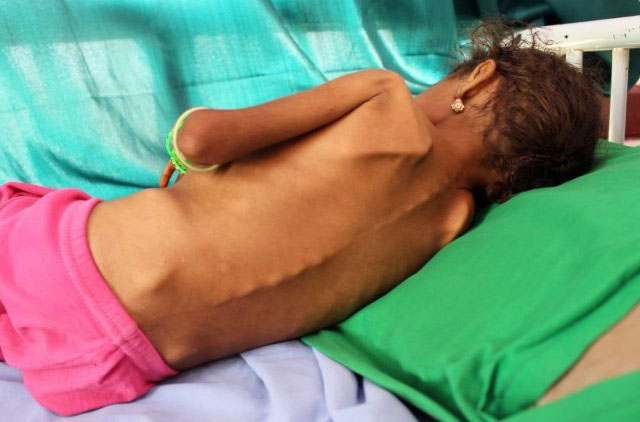Gần 100 ngàn trẻ em Yemen có nguy cơ tử vong vì suy dinh dưỡng nặng