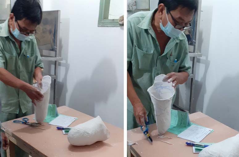 Caritas Sài Gòn: Hỗ trợ lắp chân giả cho Người khuyết tật